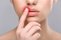 Come eliminare l'herpes labiale?